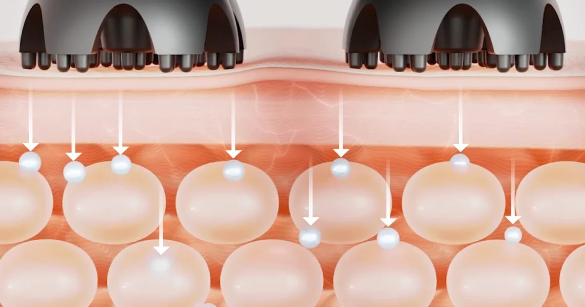 công nghệ ion X trong máy massage đầu Mytrex Head Spa Pro